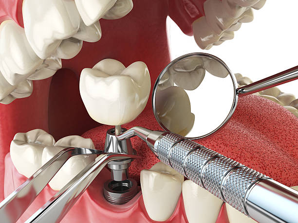 Best Dental Abscess Treatment in Taylorvle, IL